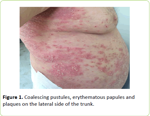 archives-inflammation-Coalescing-pustules