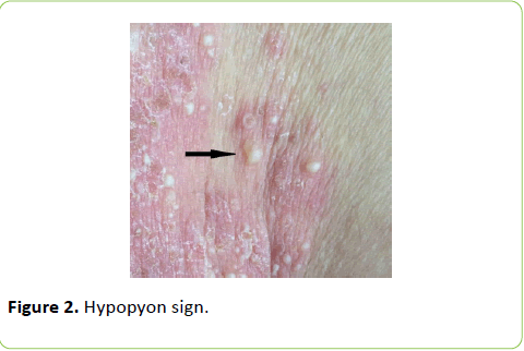 archives-inflammation-Hypopyon-sign