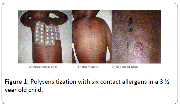 archives-inflammation-Polysensitization