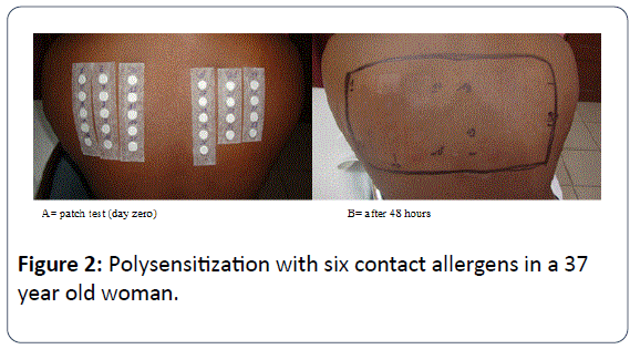 archives-inflammation-contact-allergens